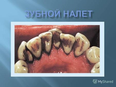 скопление бактерий в виде плёнки, образующееся на зубах ( в том числе и здорового человека ). Зубной налёт начинает образовываться уже через 1-2 часа.