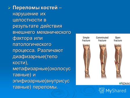 Переломы костей – нарушение их целостности в результате действия внешнего механического фактора или патологического процесса. Различают диафизарные(тело.