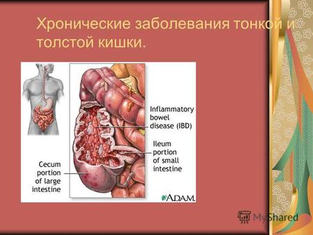 Хронические заболевания тонкой и толстой кишки.. Хронический энтерит - хроническое полиэтиологическое воспалительное заболевание тонкой кишки с нарушением.