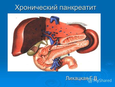 Хронический панкреатит Лихацкая Г.В. Хронический панкреатит - понятие, которое характеризует хроническое воспалительное повреждение ткани поджелудочной.