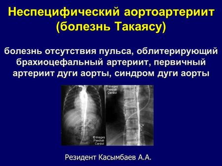 Неспецифический аортоартериит (болезнь Такаясу) болезнь отсутствия пульса, облитерирующий брахиоцефальный артериит, первичный артериит дуги аорты, синдром.