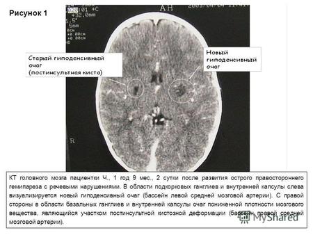 Рисунок 1 КТ головного мозга пациентки Ч., 1 год 9 мес., 2 сутки после развития острого правостороннего гемипареза с речевыми нарушениями. В области подкорковых.