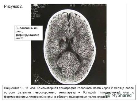 Пациентка Ч., 11 мес. Компьютерная томография головного мозга через 2 месяца после острого развития левостороннего гемипареза – большой гиподенсивный очаг.