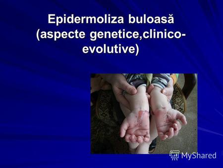 Epidermoliza buloasă (aspecte genetice,clinico- evolutive)