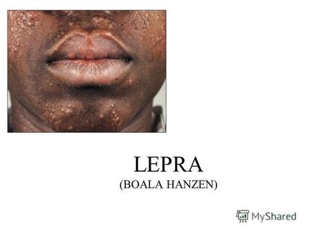LEPRA (BOALA HANZEN). DEFINIŢIE Lepra este o maladie cronică, infecţioasă cauzată de Micobacterum leprae (bacilul Hansen), ale cărei manifestări clinice.