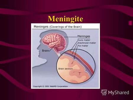 Meningite Meningita reprezintă o inflamaţie a leptomeningelui şi a lichidului cefalorahidian cauzată de o infecţie bacteriană, virală, micotică sau de.