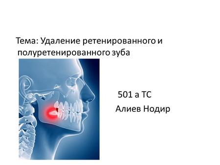 Тема: Удаление ретенированного и полуретенированного зуба 501 а ТС Алиев Нодир.