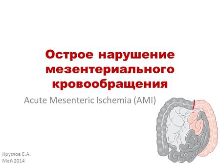 Острое нарушение мезентериального кровообращения Acute Mesenteric Ischemia (AMI) Круглов Е.А. Май 2014.