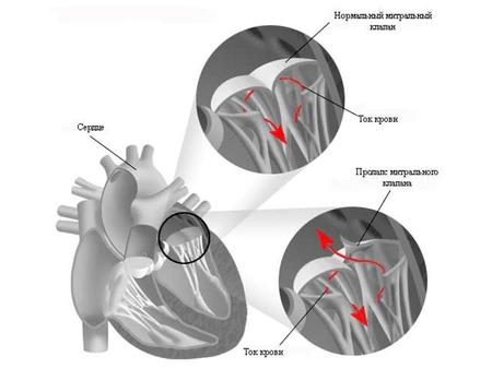 Митральный стеноз – порок сердца, при котором суженное митральное отверстие служит препятствием для изгнания крови из левого предсердия в левый желудочек.