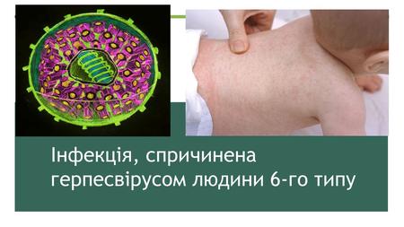 Інфекція, спричинена герпесвірусом людини 6-го типу.