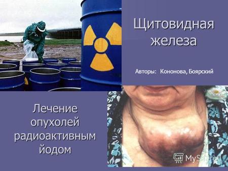 Щитовидная железа Лечение опухолей радиоактивным йодом Авторы: Кононова, Боярский.