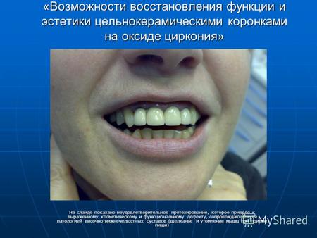 Зуб Литой Фото