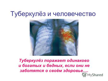 Туберкулёз и человечество Туберкулёз поражает одинаково и богатых и бедных, если они не заботятся о своём здоровье….