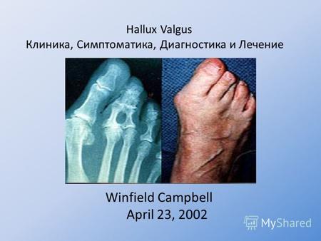 Hallux Valgus Клиника, Симптоматика, Диагностика и Лечение Winfield Campbell April 23, 2002.