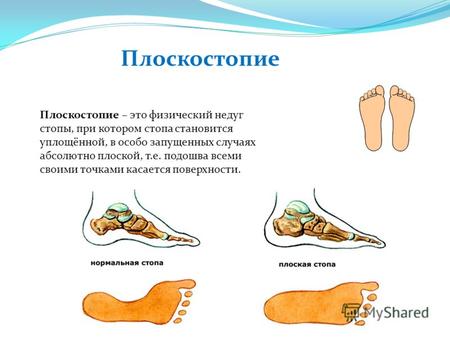 Плоскостопие Плоскостопие – это физический недуг стопы, при котором стопа становится уплощённой, в особо запущенных случаях абсолютно плоской, т.е. подошва.
