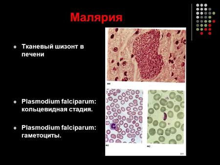 Малярия Тканевый шизонт в печени Plasmodium falciparum: кольцевидная стадия. Plasmodium falciparum: гаметоциты.