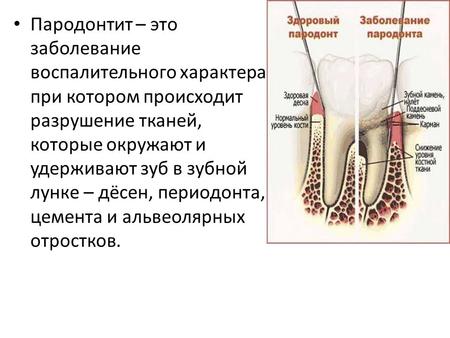 Пародонтит – это заболевание воспалительного характера, при котором происходит разрушение тканей, которые окружают и удерживают зуб в зубной лунке – дёсен,