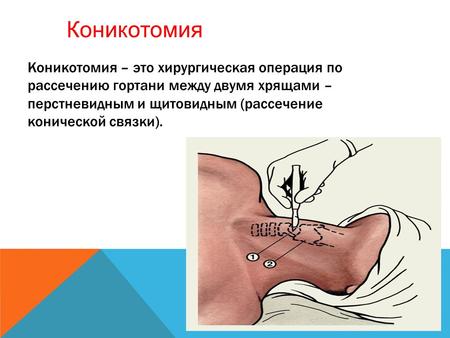 Коникотомия – это хирургическая операция по рассечению гортани между двумя хрящами – перстневидным и щитовидным (рассечение конической связки). Коникотомия.