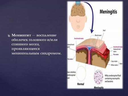 Менингит воспаление оболочек головного и/или спинного мозга, проявляющееся менингеальным синдромом. Менингит воспаление оболочек головного и/или спинного.