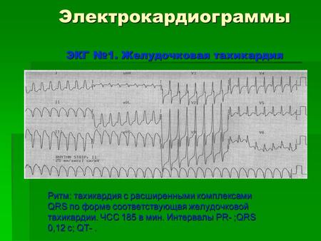 Электрокардиограммы ЭКГ 1. Желудочковая тахикардия Ритм: тахикардия с расширенными комплексами QRS по форме соответствующая желудочковой тахикардии. ЧСС.