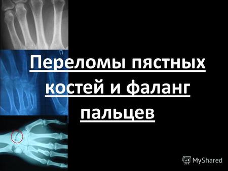 Переломы пястных костей и фаланг пальцев. Содержание: 1.Эпидемиология 2.Переломы II-IV пястных костей 3.Перелом I пястной кости – Перелом Беннета – сгибательный.