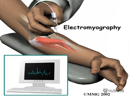 Электромиография (ЭМГ) представляет собой метод аппаратного исследования, с помощью которого определяется степень проводимости нервных окончаний и электрической.