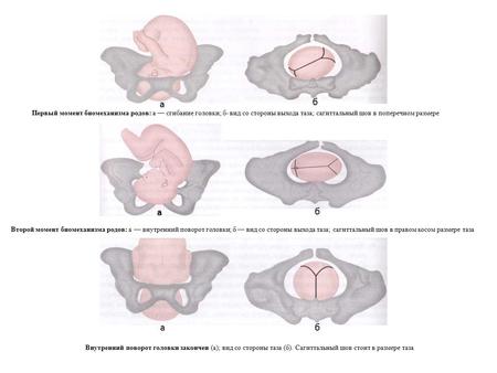 Первый момент биомеханизма родов: а сгибание головки; б- вид со стороны выхода таза; сагиттальный шов в поперечном размере Второй момент биомеханизма родов: