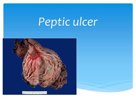 Peptic ulcer. Peptic ulcer disease (PUD), also known as a peptic ulcer or stomach ulcer, is a break in the lining of the stomach, first part of the small.