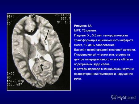 Рисунок 3А. МРТ, Т2-режим. Пациент Х., 5,5 лет, геморрагическая трансформация ишемического инфаркта мозга, 12 день заболевания. Бассейн левой средней мозговой.