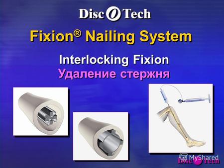 Fixion ® Nailing System Fixion ® Nailing System Interlocking Fixion Удаление стержня Interlocking Fixion Удаление стержня.