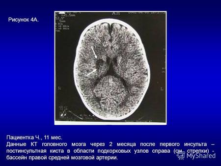 Пациентка Ч., 11 мес. Данные КТ головного мозга через 2 месяца после первого инсульта – постинсультная киста в области подкорковых узлов справа (см. стрелки)