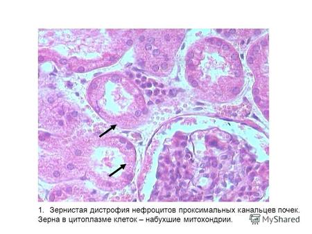 1.Зернистая дистрофия нефроцитов проксимальных канальцев почек. Зерна в цитоплазме клеток – набухшие митохондрии.