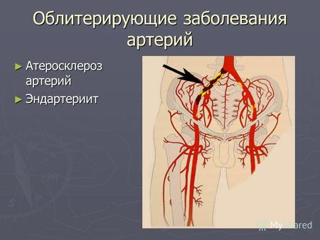 Облитерирующие заболевания артерий Атеросклероз артерий Атеросклероз артерий Эндартериит Эндартериит.