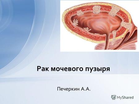 Печеркин А.А. Рак мочевого пузыря. В структуре онкологической заболеваемости населения РФ РМП занимает 8-е место среди мужчин и 18-е среди женщин. РМП.