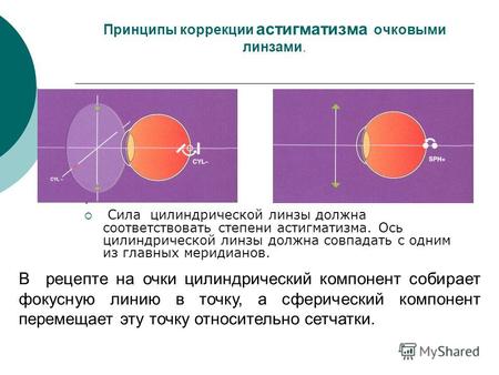 Принципы коррекции астигматизма очковыми линзами.. Сила цилиндрической линзы должна соответствовать степени астигматизма. Ось цилиндрической линзы должна.