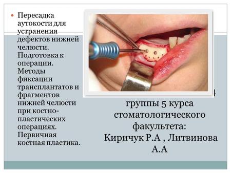 Выполнили: студенты 24 группы 5 курса стоматологического факультета: Киричук Р.А, Литвинова А.А Пересадка аутокости для устранения дефектов нижней челюсти.