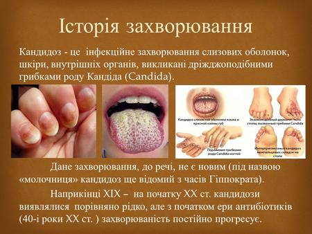 Кандидоз - це інфекційне захворювання слизових оболонок, шкіри, внутрішніх органів, викликані дріжджоподібними грибками роду Кандіда (Candida). Дане захворювання,