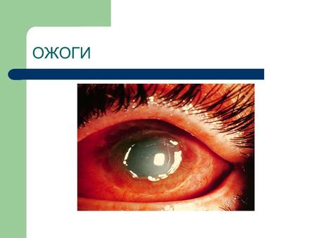 ОЖОГИ Ожоги составляют 15-30% от всех травм глаза. От 40 до 50% больных становятся инвалидами. Ожоги глаз относятся к одному из самых тяжелых видов поражения.