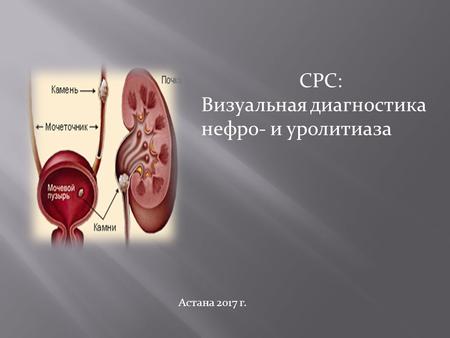 СРС: Визуальная диагностика нефро- и уролитиаза Астана 2017 г.