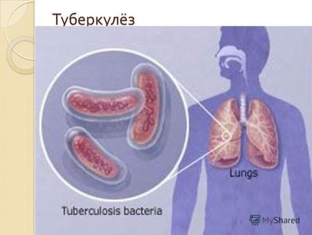 Туберкулёз Различают открытую и закрытую формы туберкулёза. При открытой форме в мокроте или в других естественных выделениях больного ( моча, свищевое.