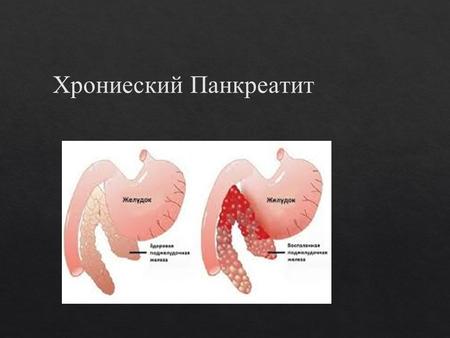 Хрониеский Панкреатит. Определение Хронический панкреатит - длительное воспалительное заболевание поджелудочной железы, проявляющееся необратимыми морфологическими.