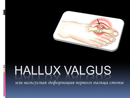 Или вальгусная деформация первого пальца стопы. Hallux Valgus Так что же такое Hallux Valgus? И почему она развивается?? Она появляется при нарушении.
