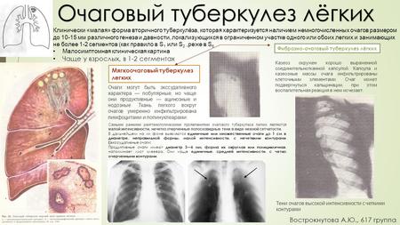 Очаговый туберкулез лёгких Клинически «малая» форма вторичного туберкулёза, которая характеризуется наличием немногочисленных очагов размером до
