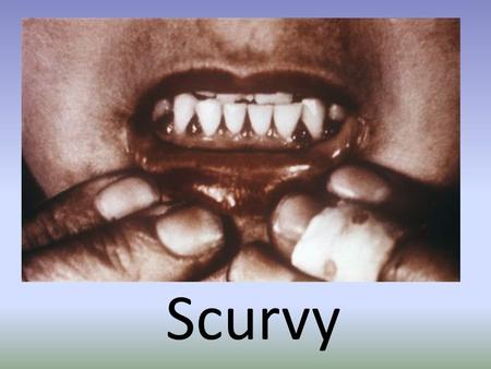 Scurvy What is scurvy Scurvy is the name for a vitamin C deficiency. It can lead to anemia, debility, exhaustion, spontaneous bleeding, pain in the limbs,