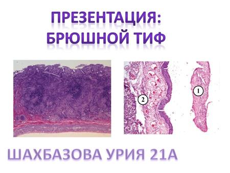 Патологическая анатомия брюшного тифа складывается из местных и общих изменений.