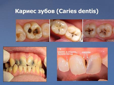 Кариес зубов (Caries dentis). Кариес - это патологический процесс, возникающий после прорезывания зубов, вследствие действия комплекса неблагоприятных.