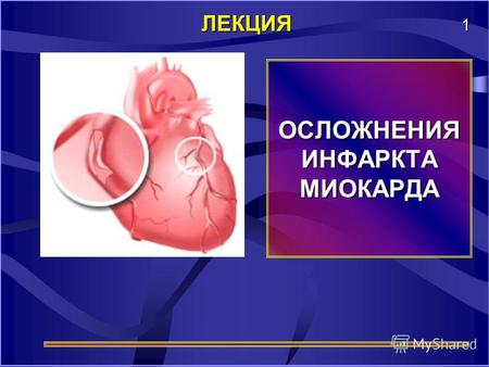 ОСЛОЖНЕНИЯ ИНФАРКТА МИОКАРДА ЛЕКЦИЯ 1. нарушения ритма и проводимости; острая левожелудочковая недостаточнось (сердечная астма, отек легких); кардиогенный.