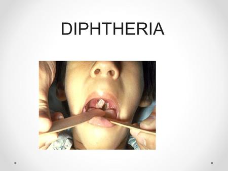 DIPHTHERIA In the immediate vicinity of the affected lymph nodes there is swelling of the subcutaneous tissue of the neck.